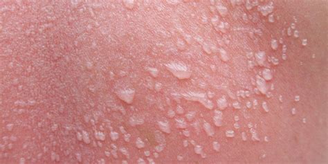 sunburn weeping|Sun Blisters: How to Treat Them and How Long They Last